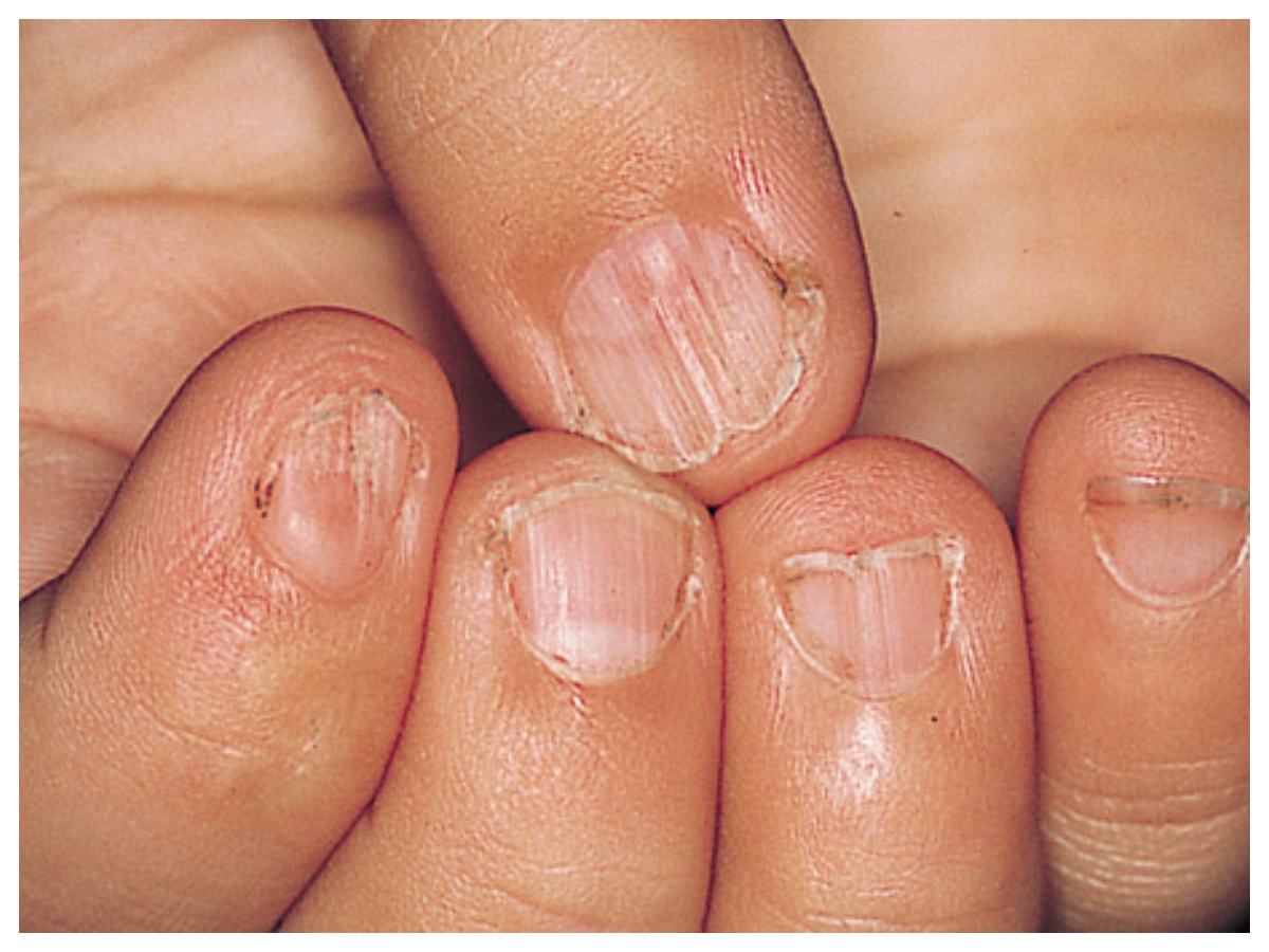 Nail health: नाखूनों में दिख रहे ये बदलाव? हो सकती है गंभीर बीमारी की चेतावनी - Photo Gallery