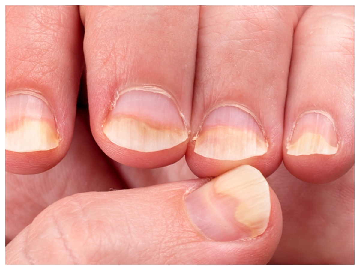 Nail health: नाखूनों में दिख रहे ये बदलाव? हो सकती है गंभीर बीमारी की चेतावनी - Photo Gallery