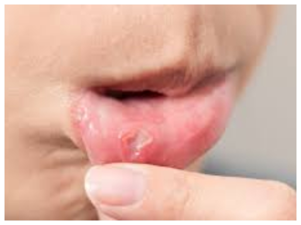 Mouth ulcers remedies: मुंह के छालों से कैसे पाएं राहत ? अपनाएं आसान घरेलू उपाय - Photo Gallery