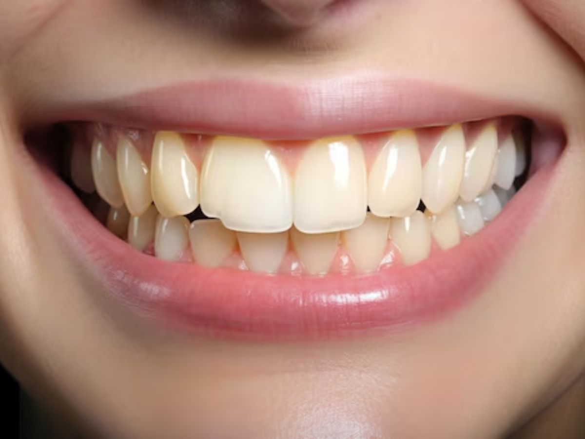 Sugar Effects On Teeth: क्या सच में चीनी खाने से पीले हो जाते हैं दांत, जानें और क्या होती है दिक्कतें? - Photo Gallery