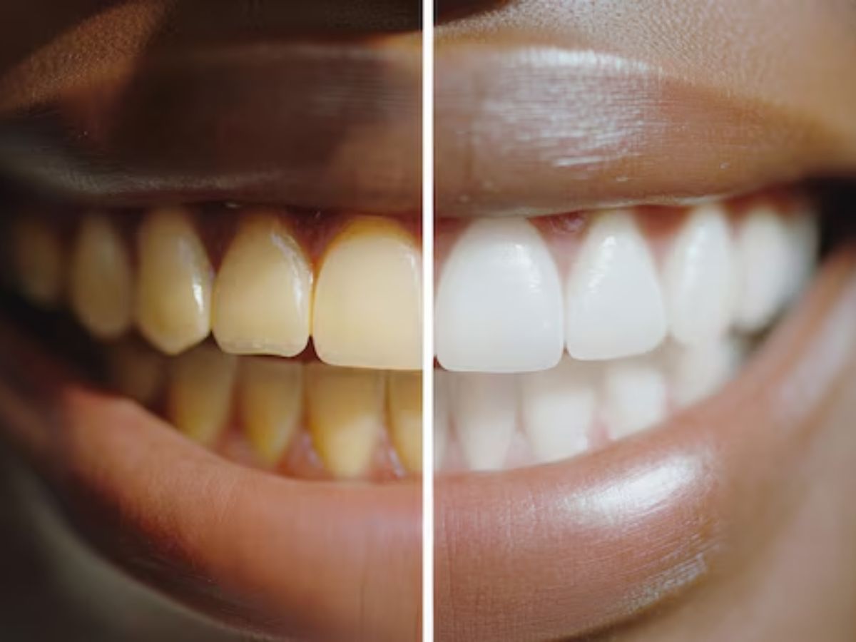 Sugar Effects On Teeth: क्या सच में चीनी खाने से पीले हो जाते हैं दांत, जानें और क्या होती है दिक्कतें? - Photo Gallery