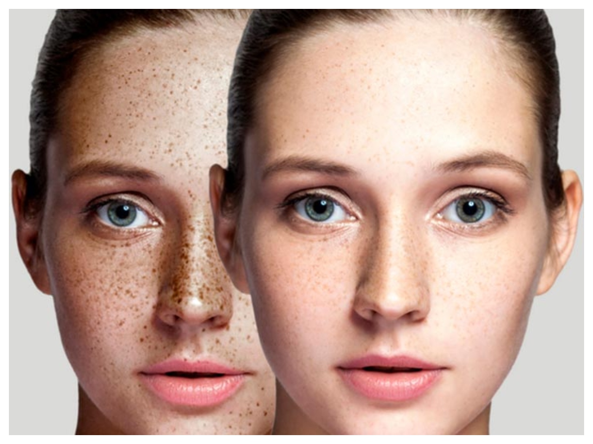 Dark spots skin: पिगमेंटेशन से हैं परेशान, इन घरेलू उपायों से पाएं छुटकारा - Photo Gallery